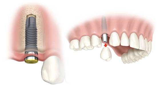 bang-gia-rang-gia-implant-tai-nha-khoa-hoan-my