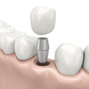 Dental-Imp7lants