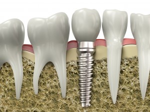 50 tuổi có nên cấy răng Implant không?