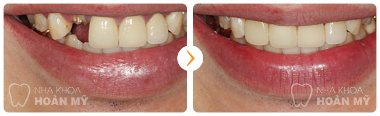 Bảng giá cấy ghép implant tại Nha khoa Hoàn Mỹ Bảng giá cấy ghép implant tại Nha khoa Hoàn Mỹ