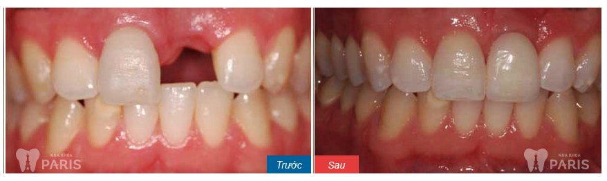 dental-implants-before-and-after1