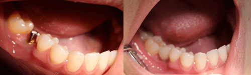 Răng cấm bị sâu nặng có nên nhổ hay không