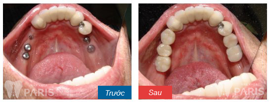 Cách phục hồi răng mất toàn hàm đảm bảo nhất?