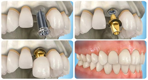 Trồng răng implant giá bao nhiêu tiền?Giá ƯU ĐÃI khủng2