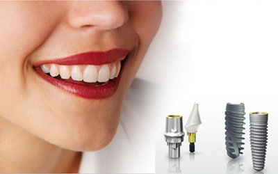 Trồng răng răng implant giá bao nhiêu tiền? 