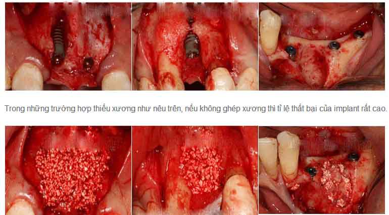 Ghép xương răng ở đâu an toàn và tốt nhất hiện nay? Ghép xương răng ở đâu an toàn và tốt nhất hiện nay? 4