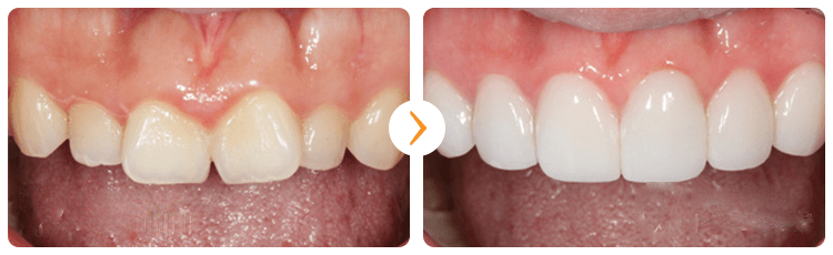 Làm răng veneer sứ với CN tiên tiến BỀN ĐẸP tự nhiên nhất 6