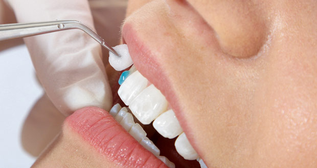 Làm răng veneer sứ với CN tiên tiến BỀN ĐẸP tự nhiên nhất 2