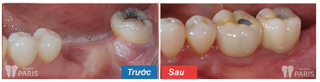 Trồng răng sứ mất bao nhiêu thời gian thưa bác sỹ?