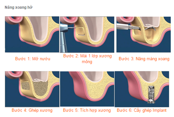Trường hợp nào cần nâng xoang hàm khi cấy implant?