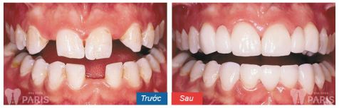 Làm mão răng sứ và những vấn đề cần biết 6
