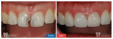 Làm mão răng sứ và những vấn đề cần biết 7