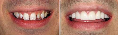 Làm răng sứ bị viêm lợi 9