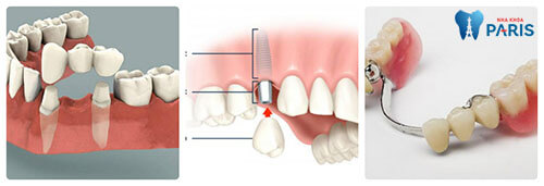 Các phương pháp trồng răng giả bạn đã biết chưa?