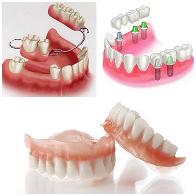 Chỉnh răng bằng hàm tháo lắp - Giải Pháp thay thế răng "tiết kiệm" nhất 2 Chỉnh răng bằng hàm tháo lắp - Giải Pháp thay thế răng "tiết kiệm" nhất 2