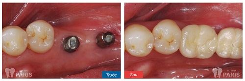 Quy trình cắm Implant thế nào là chuẩn và đảm bảo hiệu quả, an toàn? 3 Quy trình cắm Implant thế nào là chuẩn và đảm bảo hiệu quả, an toàn? 3