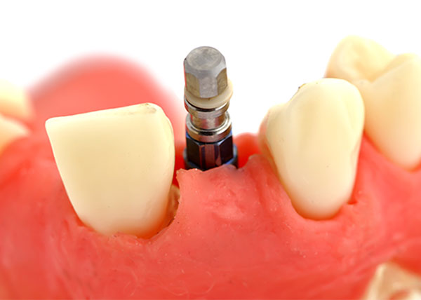 Có nên làm răng Implant không 1 