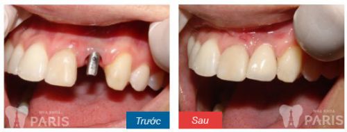 Bật mí kỹ thuật làm răng implant an toàn hiệu quả nhất 5