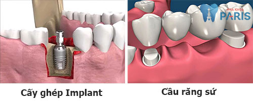 3 Yếu tố chi phối quyết định nên làm răng Implant hay cầu răng 1 3 Yếu tố chi phối quyết định nên làm răng Implant hay cầu răng 1