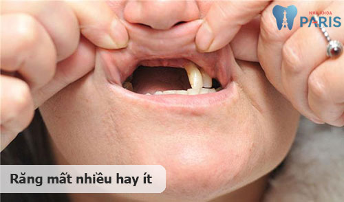 3 Yếu tố chi phối quyết định nên làm răng Implant hay cầu răng 2 3 Yếu tố chi phối quyết định nên làm răng Implant hay cầu răng 2