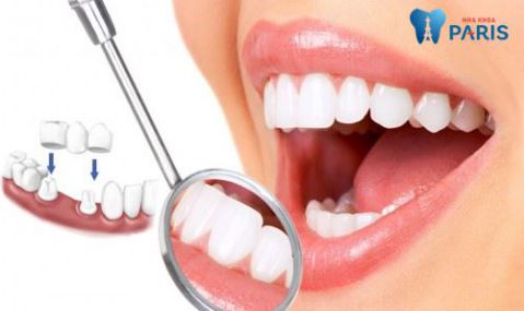 Làm cầu răng có tốt không? Cách trồng răng tốt nhất là gì? 1