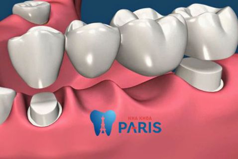 Làm cầu răng có tốt không? Cách trồng răng tốt nhất là gì? 3
