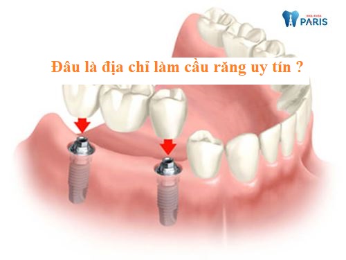 [Chia Sẻ] Địa chỉ làm cầu răng ở đâu tốt - uy tín tại Hà Nội 1
