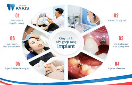 Quy trình trồng răng implant chuẩn là gì? 2