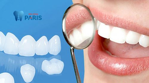 Làm răng sứ mất bao lâu - Thời gian làm răng sứ chi tiết nhất 1