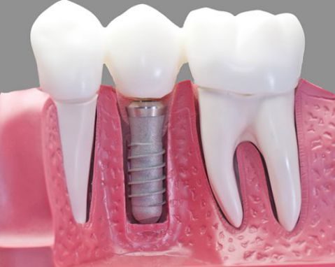 Có nên nhổ răng hàm bị sâu để trồng răng implant hay không? 3