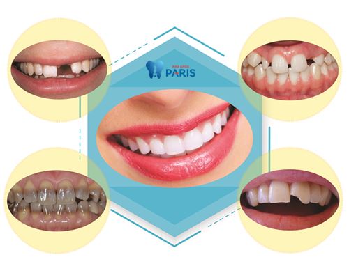 Làm mão răng sứ và những vấn đề cần biết 3