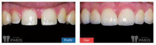 Mài cùi răng bọc sứ có đau không? [Giải đáp từ chuyên gia] 4