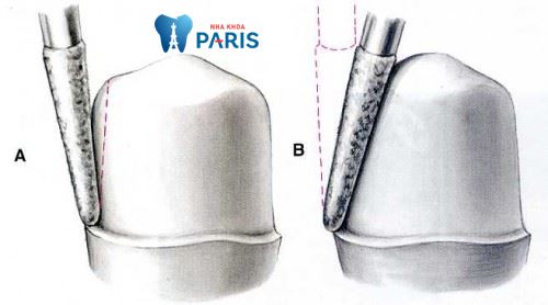 Mài cùi răng bọc sứ có đau không? [Giải đáp từ chuyên gia] 1