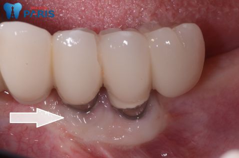 Trồng răng implant giá rẻ có tốt và được đảm bảo hay không 1