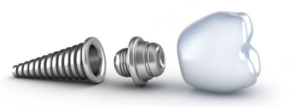 Trồng răng implant giá rẻ có tốt và được đảm bảo hay không 2