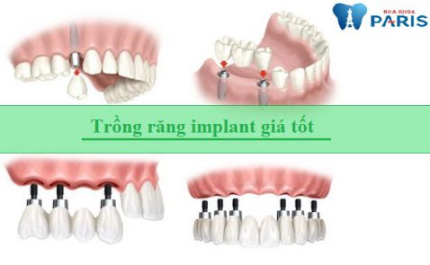 Trồng răng implant giá rẻ có tốt và được đảm bảo hay không 3