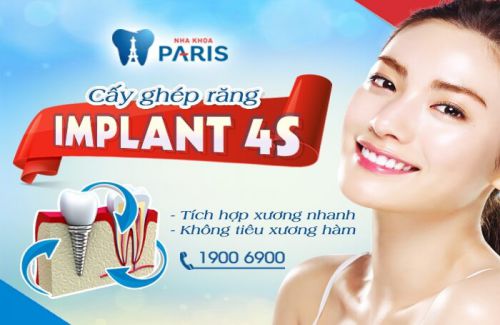 Thời gian trồng răng Implant mất bao lâu là hợp lý nhất? 1