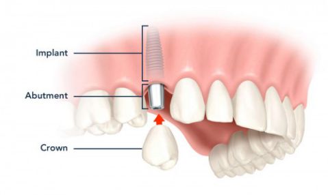 Quy trình trồng răng implant chuẩn là gì? 1