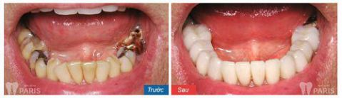 Trồng răng sứ không kim loại - Phục hình răng mất bền chắc Vĩnh Viễn 5 Trồng răng sứ không kim loại - Phục hình răng mất bền chắc Vĩnh Viễn 5
