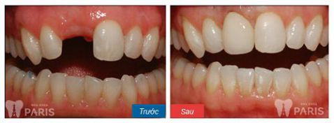 Trồng răng sứ không kim loại - Phục hình răng mất bền chắc Vĩnh Viễn 6 Trồng răng sứ không kim loại - Phục hình răng mất bền chắc Vĩnh Viễn 6