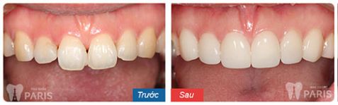 Trồng răng sứ không kim loại - Phục hình răng mất bền chắc Vĩnh Viễn 7 Trồng răng sứ không kim loại - Phục hình răng mất bền chắc Vĩnh Viễn 7