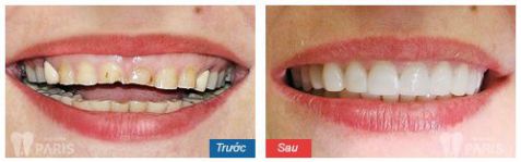 Trồng răng sứ không kim loại - Phục hình răng mất bền chắc Vĩnh Viễn 8 Trồng răng sứ không kim loại - Phục hình răng mất bền chắc Vĩnh Viễn 8