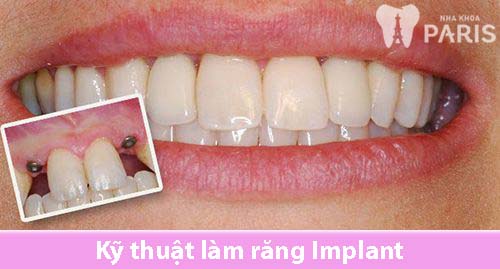 Bật mí kỹ thuật làm răng implant an toàn hiệu quả nhất 1