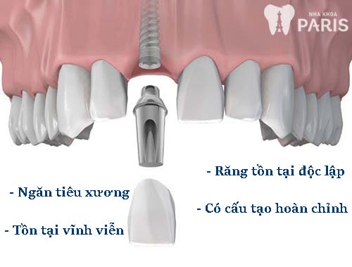Sự thật: cấy ghép răng implant có tốt không 1