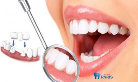 răng khểnh có hại không [Giải đáp từ chuyên gia tư vấn] 3