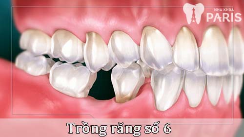 Giá trồng răng số 6 có chi phí bao nhiêu [Bảng giá CHUẨN nhất 2018] 1