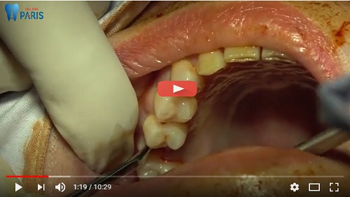 Tổng hợp các kinh nghiệm làm răng implant hưu ích nhất 4