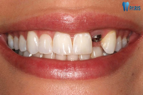 Tổng hợp các kinh nghiệm làm răng implant hưu ích nhất 2