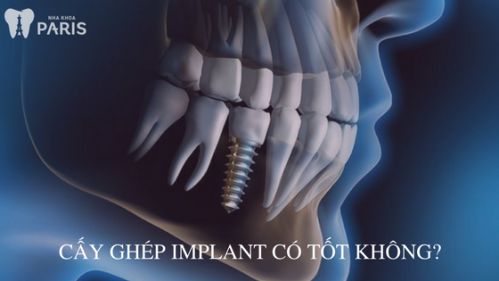Cấy ghép implant có tốt không? 1