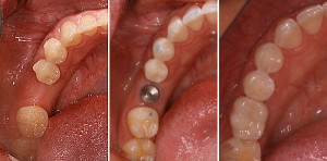 Cấy ghép răng implant là gì?Ưu điểm vượt trội của implant